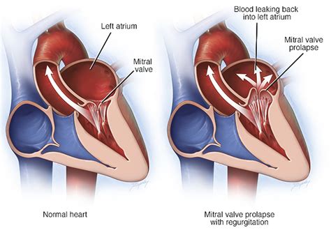 Mitral Valve Prolapse - Causes, Symptoms, Diagnosis, Treatment