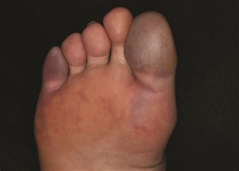 Painful Purple Toes | MDedge Dermatology