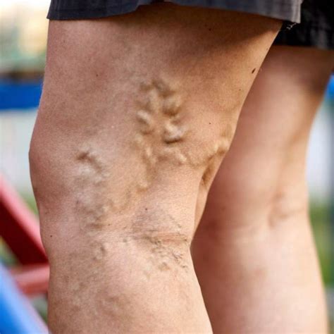 Varicose veins cause and risk factors | Symptoms of varicose veins ...