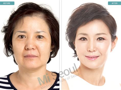 Korean Face Lift Korean Thread Lifting â€“ Everything That You Should ...