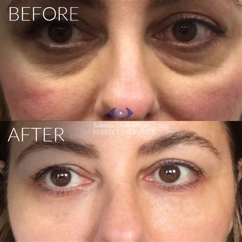 Tear Trough Fillers: Dark Circles And Eye Bags | Perfect Eyes Ltd ...