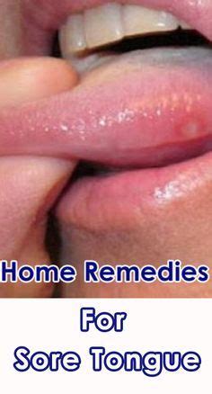 Home Remedies for Treating Sore Tongue - Getinfopedia.com | Tongue ...