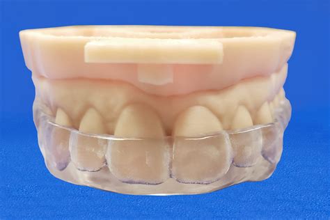 Bite Splints - Classic Craft Dental Lab