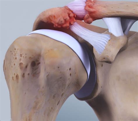 Acromioclavicular Joint Problems - Dr. Erik Hohmann