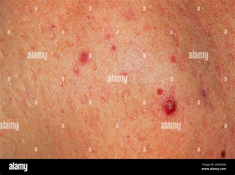 Acne vulgaris scars. Close-up of old scars from the skin disorder acne ...