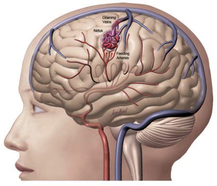 Arteriovenous Malformation (AVM) - Anavara