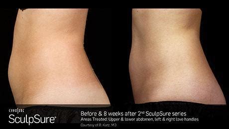 Sculpsure Before & After Gallery | Bay Area Osteopathic