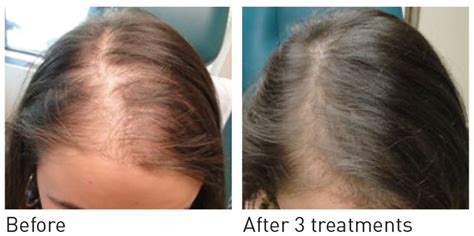 PRP Hair Restoration - Rejuva Medispa & Laser