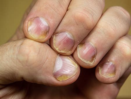 Nail Psoriasis – Causes, Symptoms and Treatments