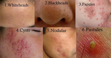 Types of Acne | Back acne treatment, Diy acne treatment, Cystic acne ...