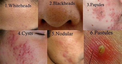 Types of Acne | Back acne treatment, Diy acne treatment, Cystic acne ...