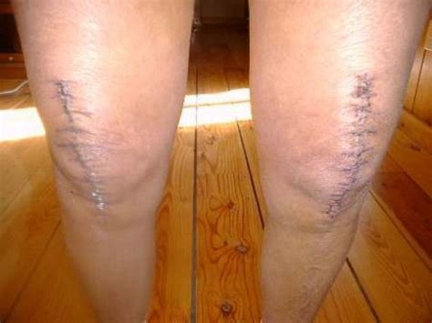 Bilateral knee replacement surgery has its own advantages and ...