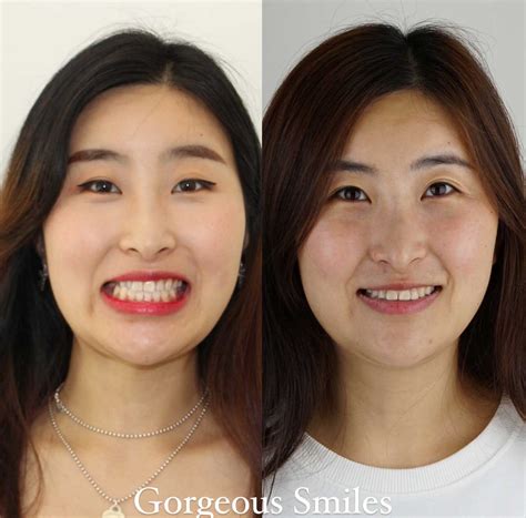 Braces Before And After Pictures - Gorgeous Smiles