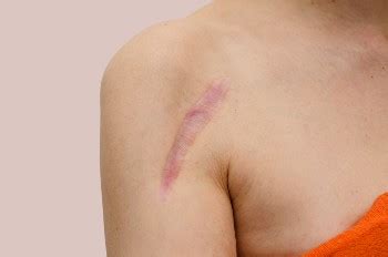 Reasons Why a Surgical Scar May Still Hurt | Dr. Eric H. Williams