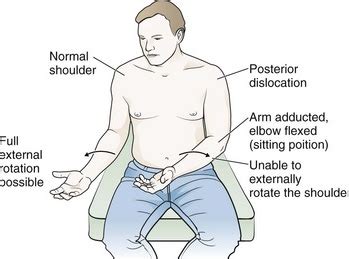 Posterior dislocation - County EM