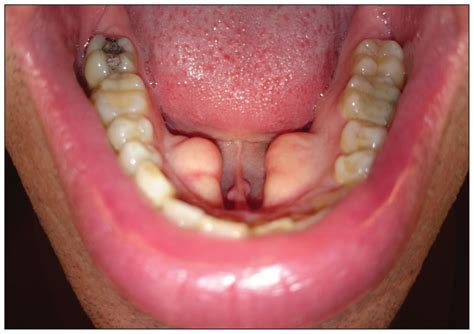 Torus Mandibularis Removal