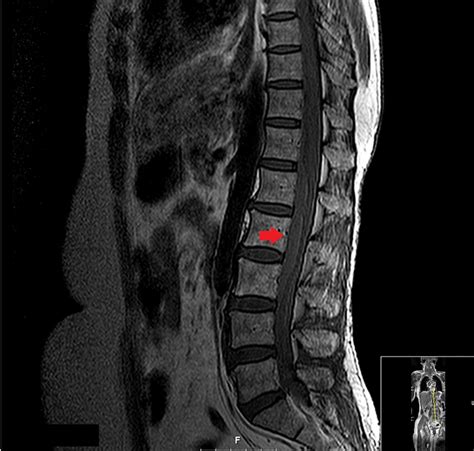 Cauda equina syndrome caused by a spontaneous spinal haematoma | BMJ ...