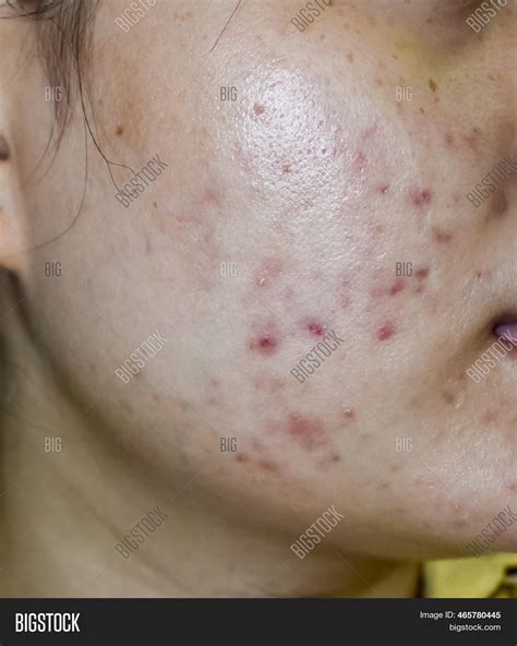 Acne Vulgaris Scars On Image & Photo (Free Trial) | Bigstock