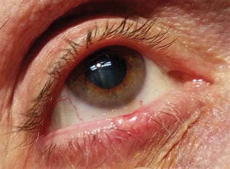 Eyelid Seborrheic Keratosis