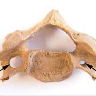 Bilateral duplication of foramen transversarium (FT). Figure 3 ...