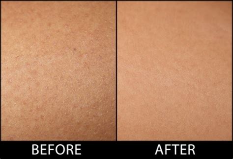 Keratosis Pilaris Treatment — Sharon Gordon SKIN