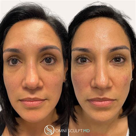 Under Eye Filler Before & After Gallery | OMNI SCULPT MD