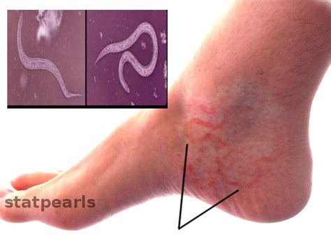 [Figure, Hookworm infection Image courtesy O.Chaigasame] - StatPearls ...