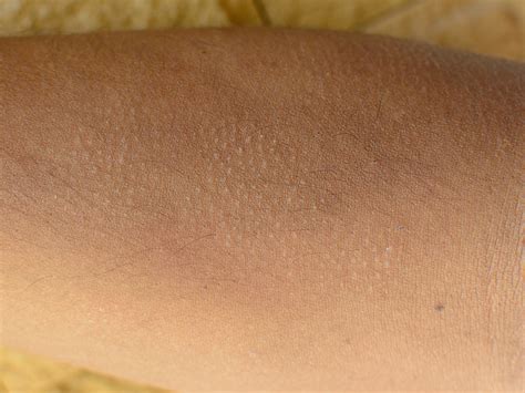 What Is Keratosis Pilaris And What Causes It? – Balmonds