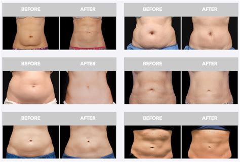 Choosing Between CoolSculpting and Liposuction — Cleverly Catheryn