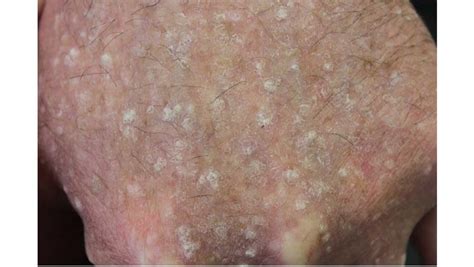 Stucco Keratosis: Causes, Symptoms and Treatments | Skin Cancer Specialists