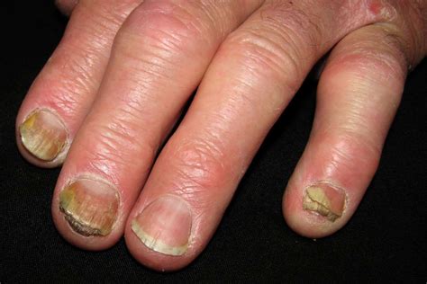 Nail Psoriasis vs. Fungus: Symptoms, Causes, Treatment