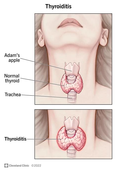 Thyroid: Causes, Symptoms and Treatment - Public Health Notes