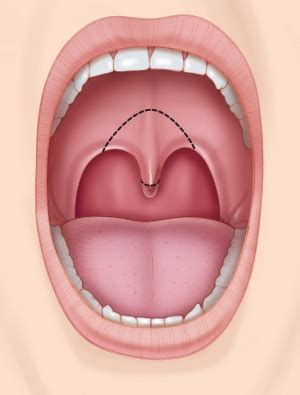 Uvulopalatopharyngoplasty (UPPP) | Stanford Health Care