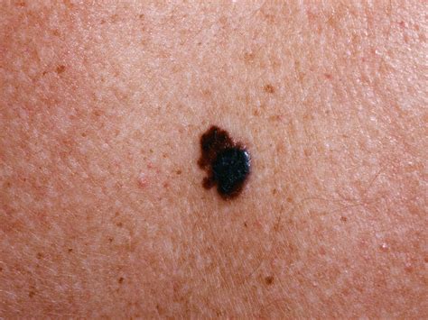 Black Mole Melanoma Skin Cancer