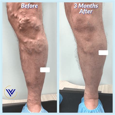 How Long is the Recovery Period After Varicose Vein Treatment? : Center ...