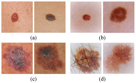 Benign Nevus Vs Melanoma