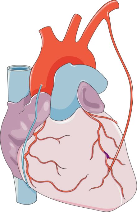 Coronary Artery Bypass Grafting - Servier Medical Art