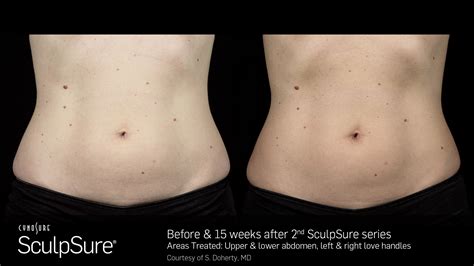 SculpSure® Before & After Photos | Coastal Aesthetics