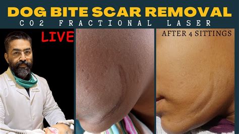 dog bite scar removal #co2fractionallaser resurfacing surgery #scar # ...