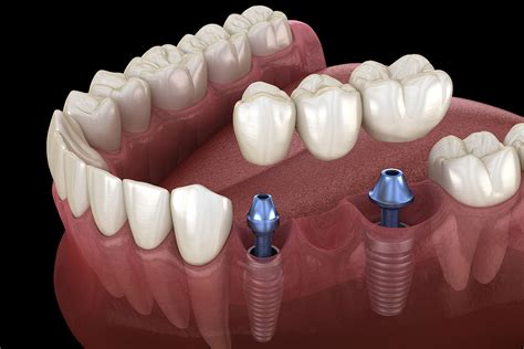 Dental Bridge vs Implant - Pros and Cons and How To Choose | Somerset ...