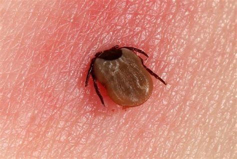 Tick Bite: Pictures, Symptoms, When to Be Concerned