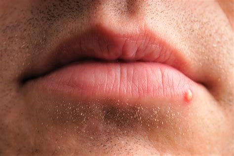 Cold Sore or Pimple: How to Tell What the Bump on Your Lip Really Is ...