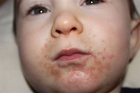 Skin Rashes For Kids