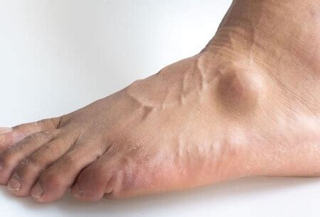 Lump On Top Of Foot: Common Causes & Treatment