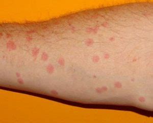 Gnat Bites - Symptoms And Causes