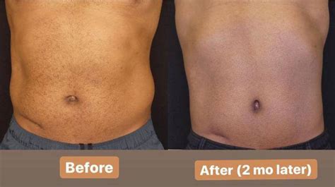 Coolsculpting Reviews - Before and After Coolsculpting