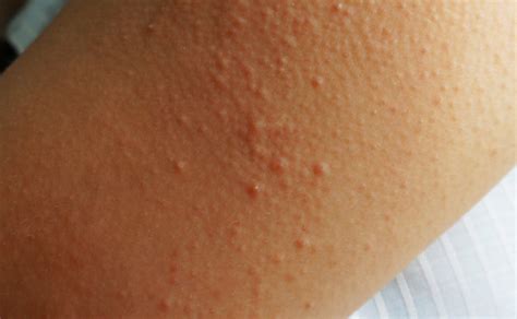 Keratosis Pilaris: What You Need to Know