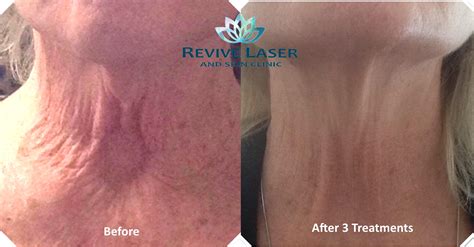 Laser Neck Tightening in Calgary - Revive Laser & Skin Clinic