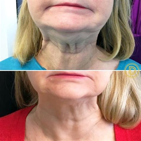 Neck Botox Dallas | Botox Neck Injections Dallas | Botox for Neck Bands ...