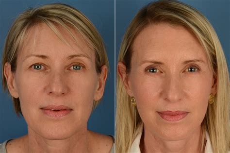 The UpLift™ Lower Face and Neck Lift Photos | Naples, FL | Patient 16233